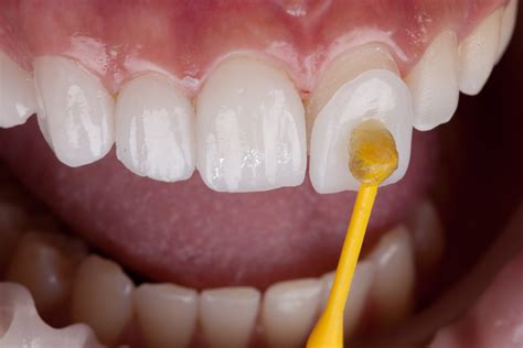 Porcelain Veneers .